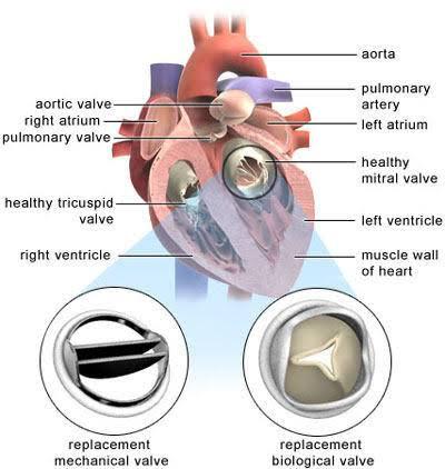 Valve Replacement