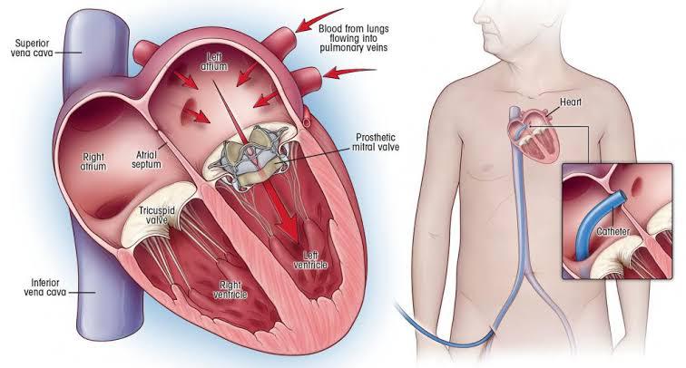 Valve Surgery